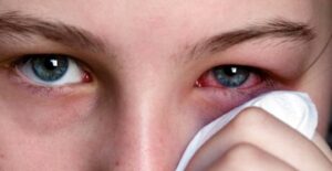 FERIŢI-VĂ DE PERSOANELE CARE PREZINTĂ CONJUNCTIVITE. SUNT ŞANSE SĂ FIE INFECTATE CU NOUL CORONAVIRUS