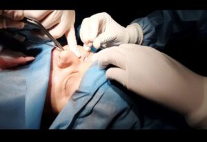VIDEO: PREMIERĂ MEDICALĂ ÎN ARGEȘ. PACIENTĂ DIAGNOSTICATĂ LA BUCUREȘTI, OPERATĂ LA S.J. PITEȘTI
