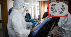 UN MEDIC DIN PITEŞTI EXPLICĂ MODIFICĂRILE PRODUSE DE CORONAVIRUS LA PLĂMÂNI / „ESTE UN CAZ GRAV”
