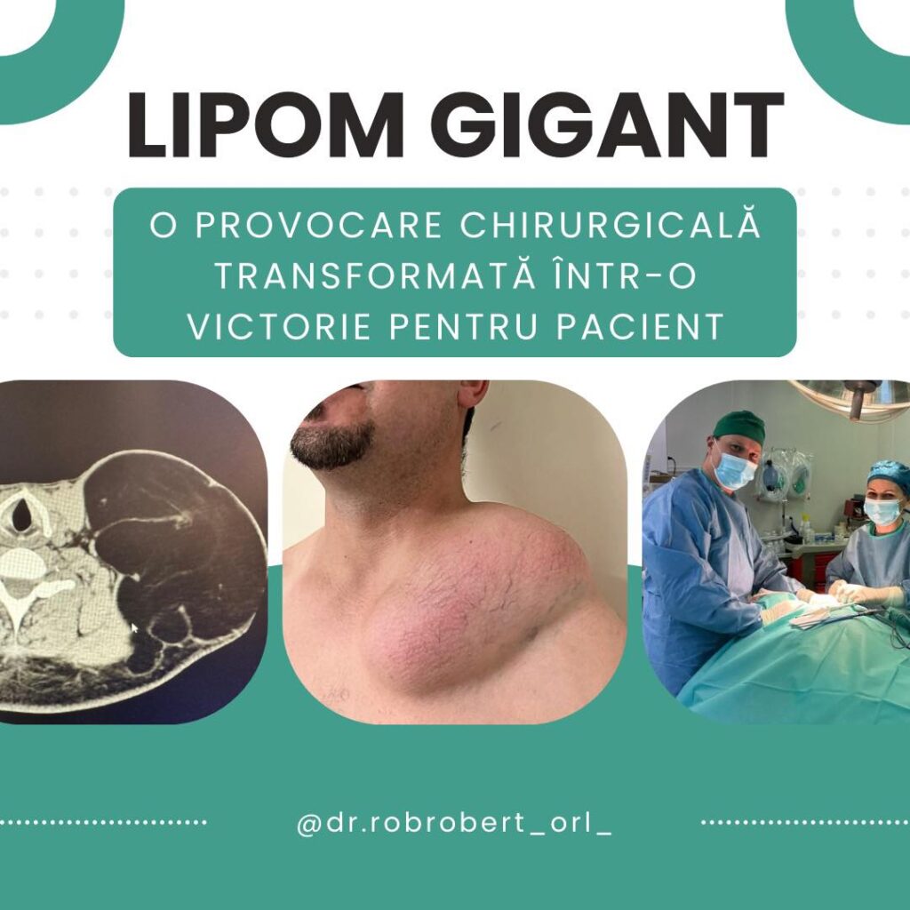Lipom gigant