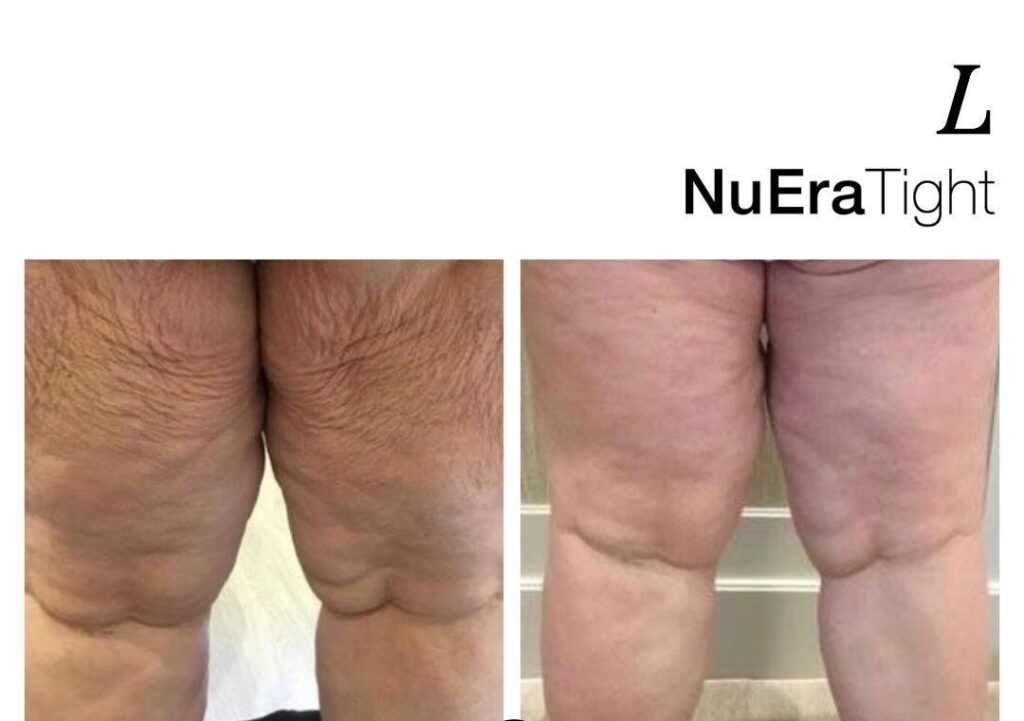 Lumenis NuEra Tight