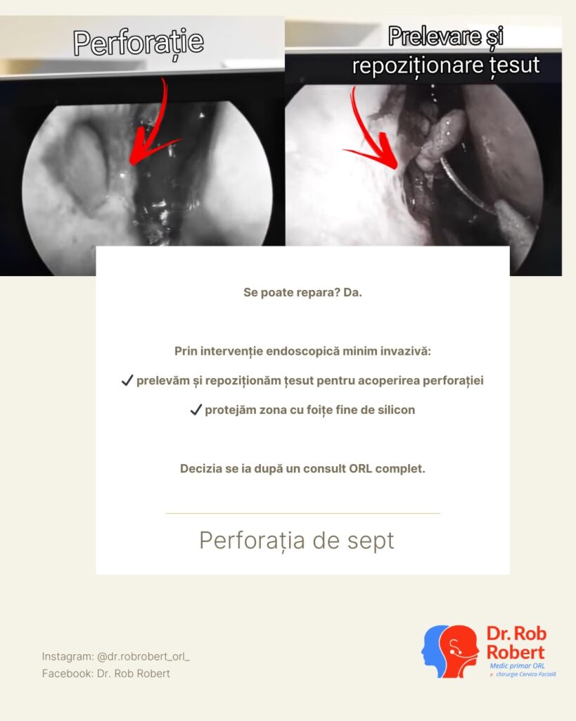 Perforația septală